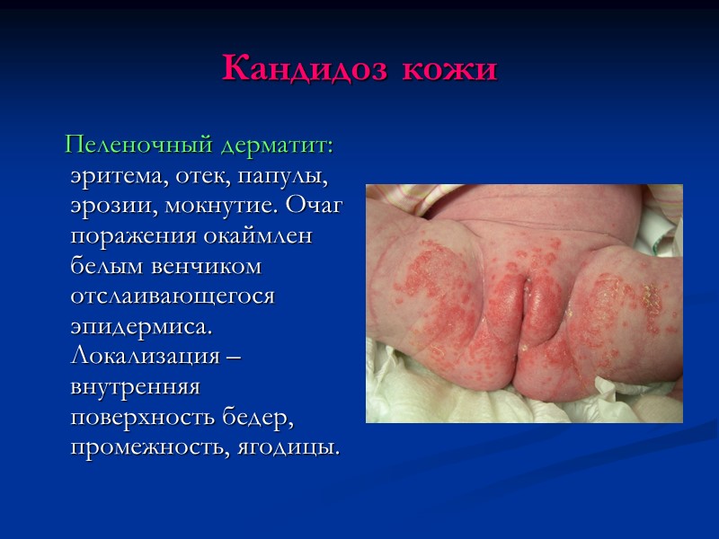 Кандидоз кожи    Пеленочный дерматит: эритема, отек, папулы, эрозии, мокнутие. Очаг поражения